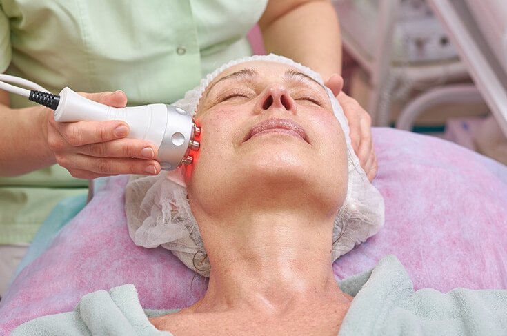 radiofrequencia rosto belight