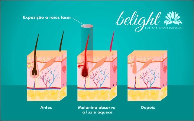 como funciona o laser 1