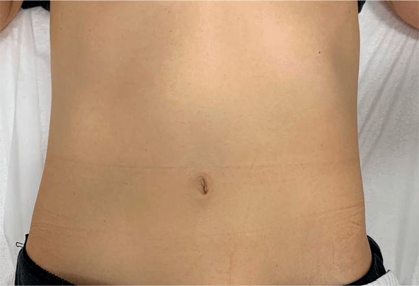 Antes Método Renata França