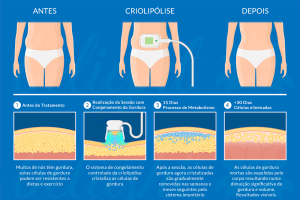 Criolipólise Antes e Depois - Explicação