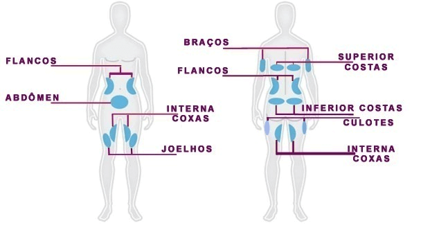Zonas de Criolipólise - Escolha 2