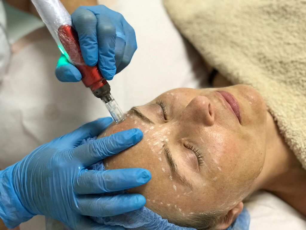 Tratamento microagulhamento