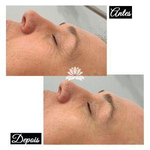 antes depois radiofrequencia