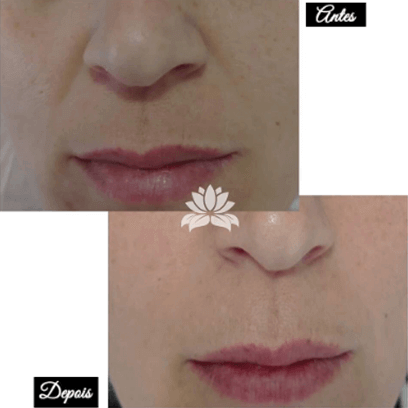 Antes e Depois Radiofrequência