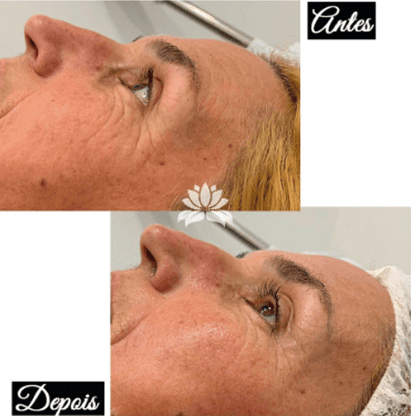 Antes e Depois Radiofrequência