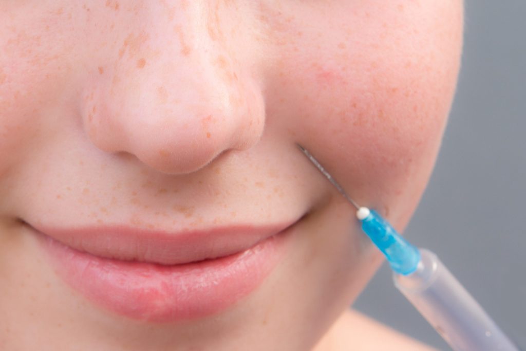 Bigode Chinês Toxina Botulínica