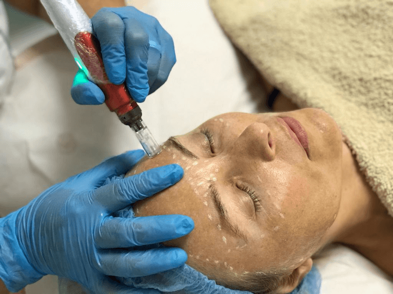 Belight Microagulhamento