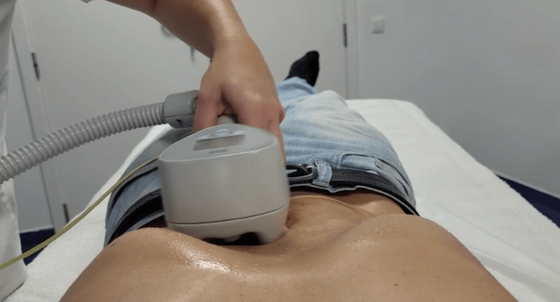 Radiofrequencia monopolar focada 2