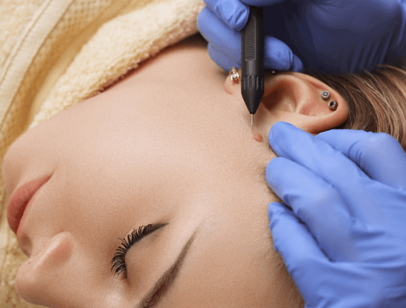 Tirar Sinais e Verrugas