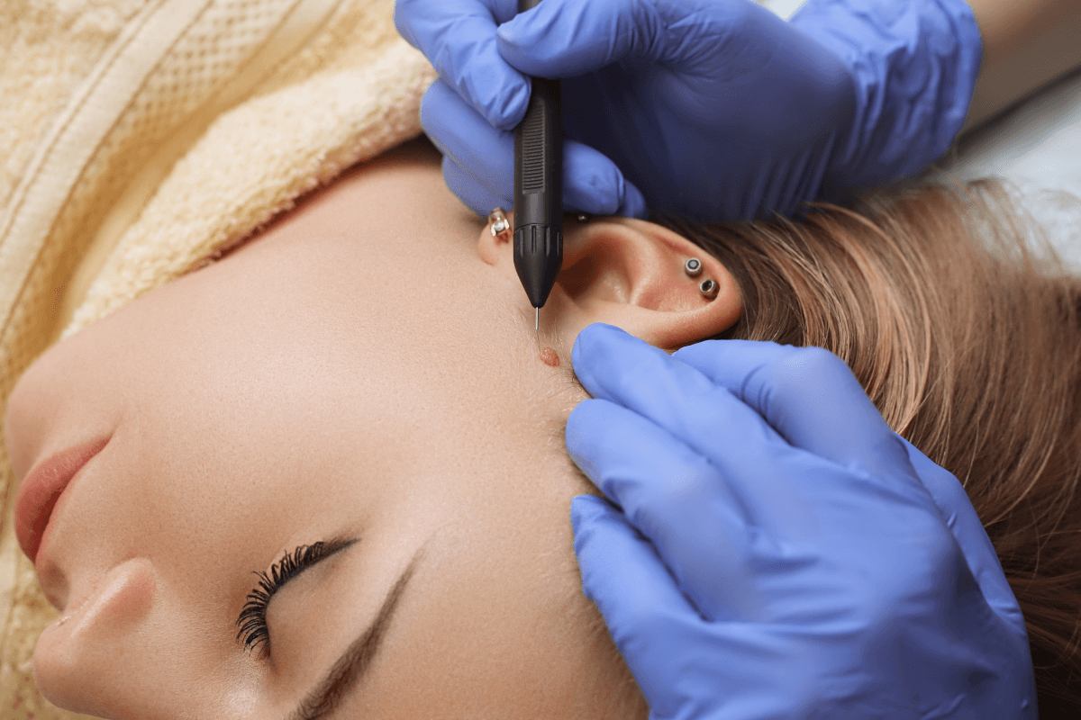 Tirar Sinais Jato de Plasma