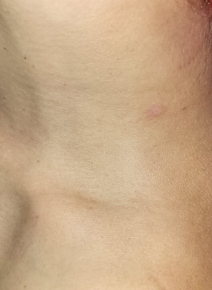 Tirar Sinais Jato de Plasma