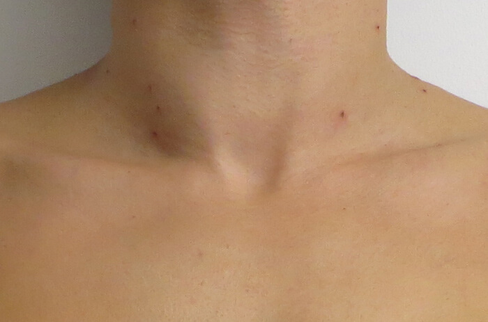 Tirar Sinais Jato de Plasma