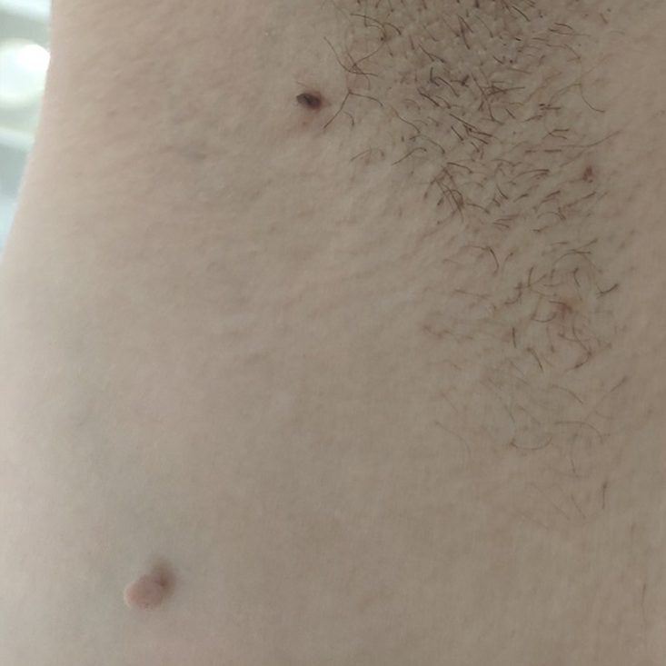 foto antes axila cliente e1669207175557