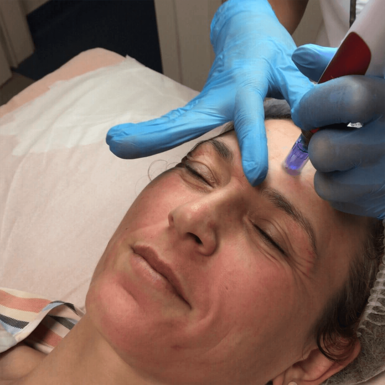 microagulhamento na belight e1665588035377