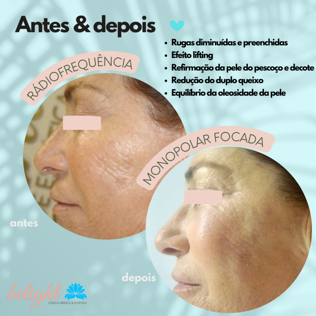 Radiofrequência Monopolar Focada