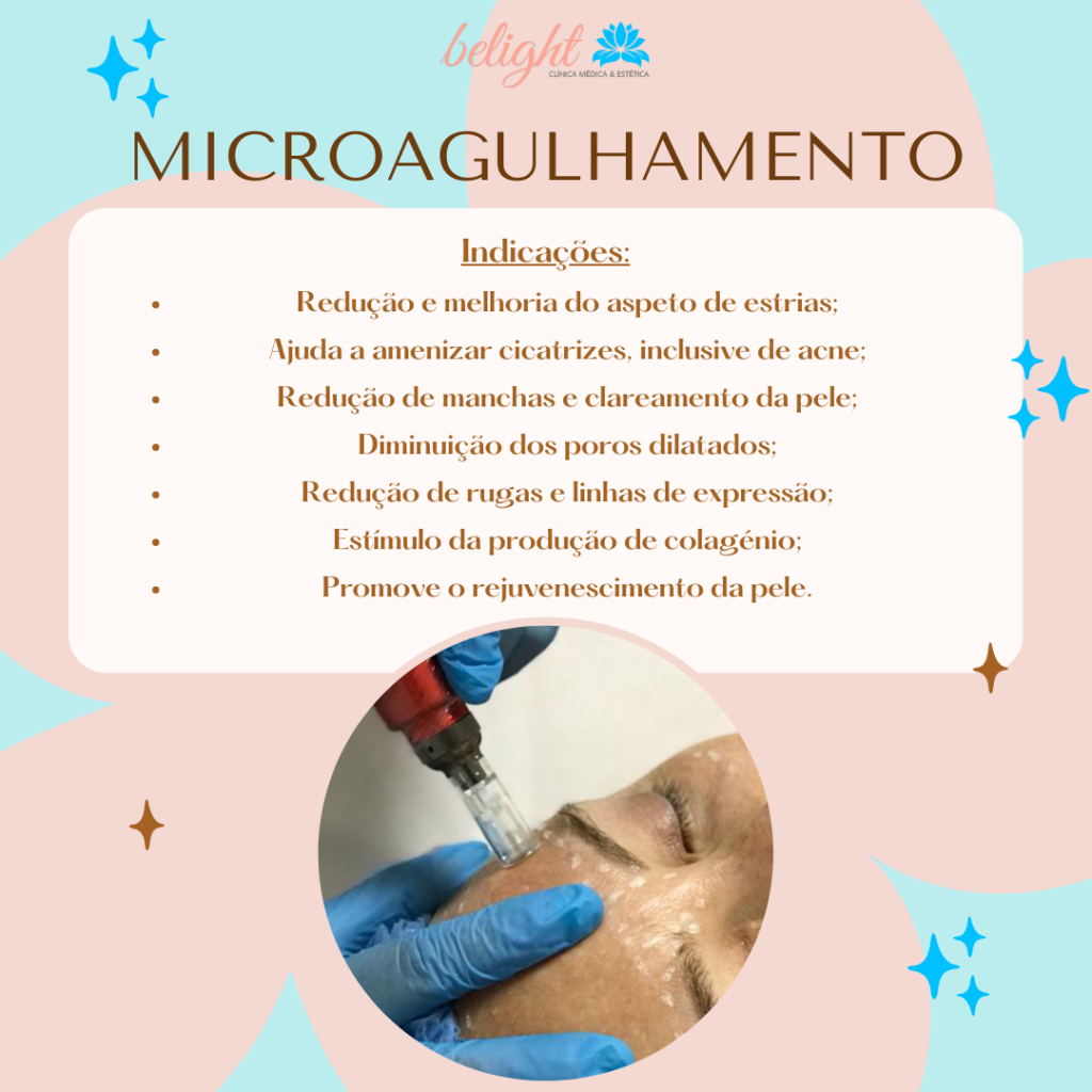 Indicações de Microagulhamento.