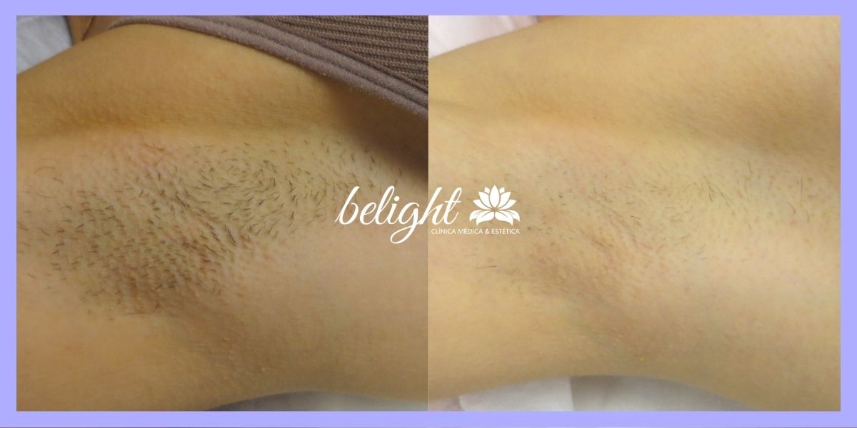 Caso 732 – Epilacao Triplo Laser