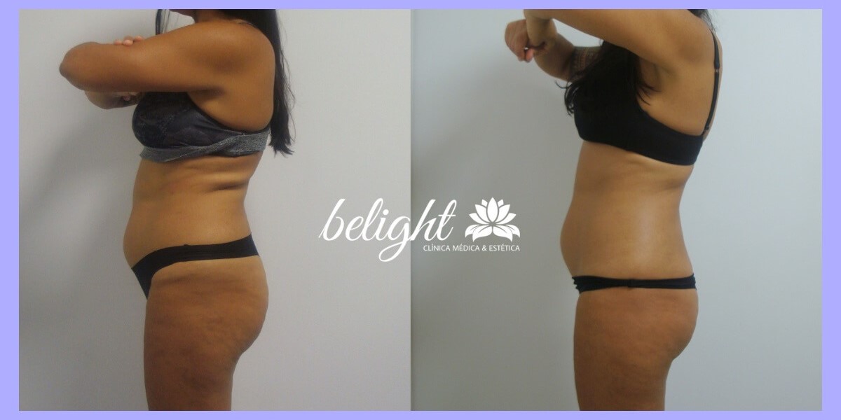 Modelo antes e depois Criolipolise 1