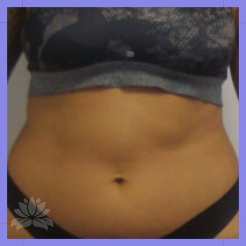 antes criolipolise frente