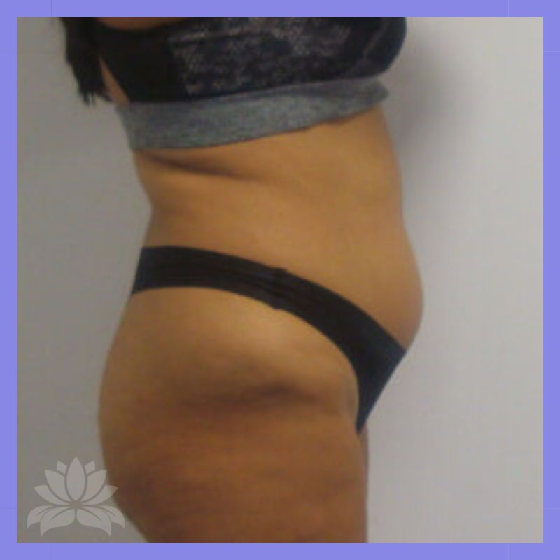 antes criolipolise lado2