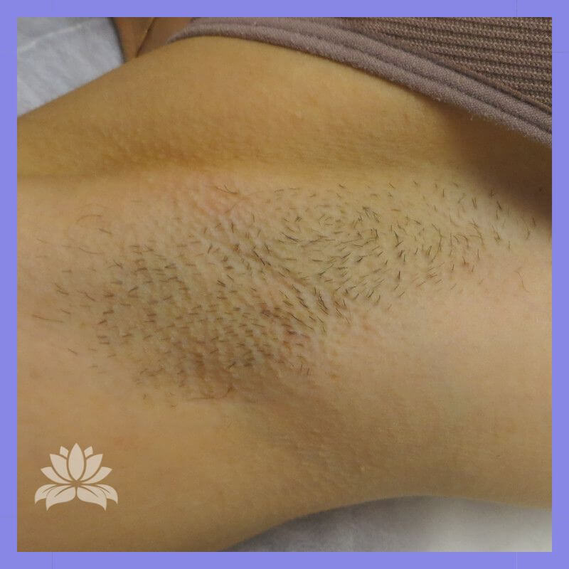 caso 732 antes e depois epilacao triplo laser axila 1