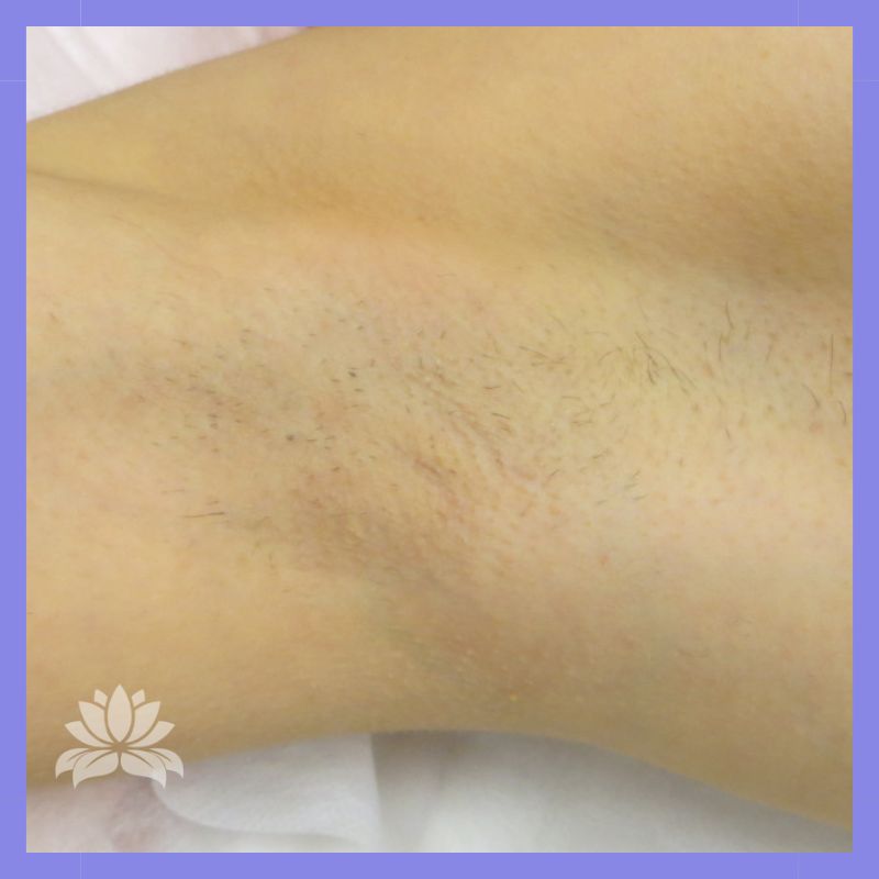 caso 732 antes e depois epilacao triplo laser axila 2