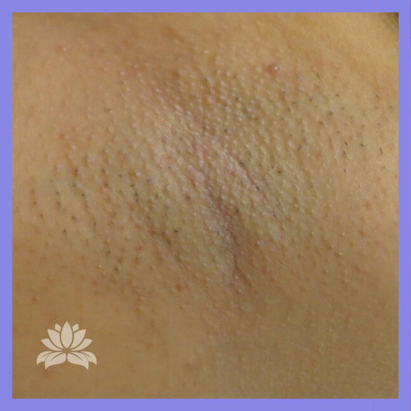 caso 908 antes depois axila 1