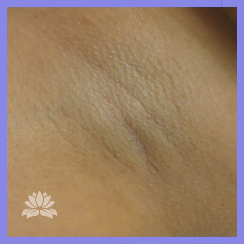 caso 908 antes depois axila 2