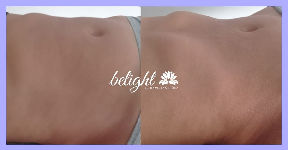 caso antes e depois dlm