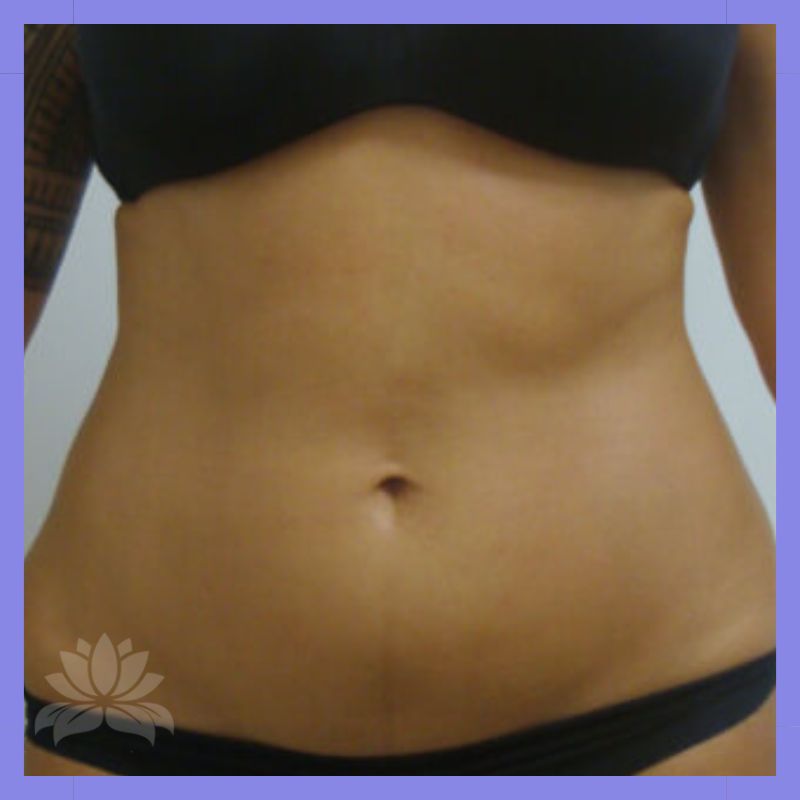 depois criolipolise frente