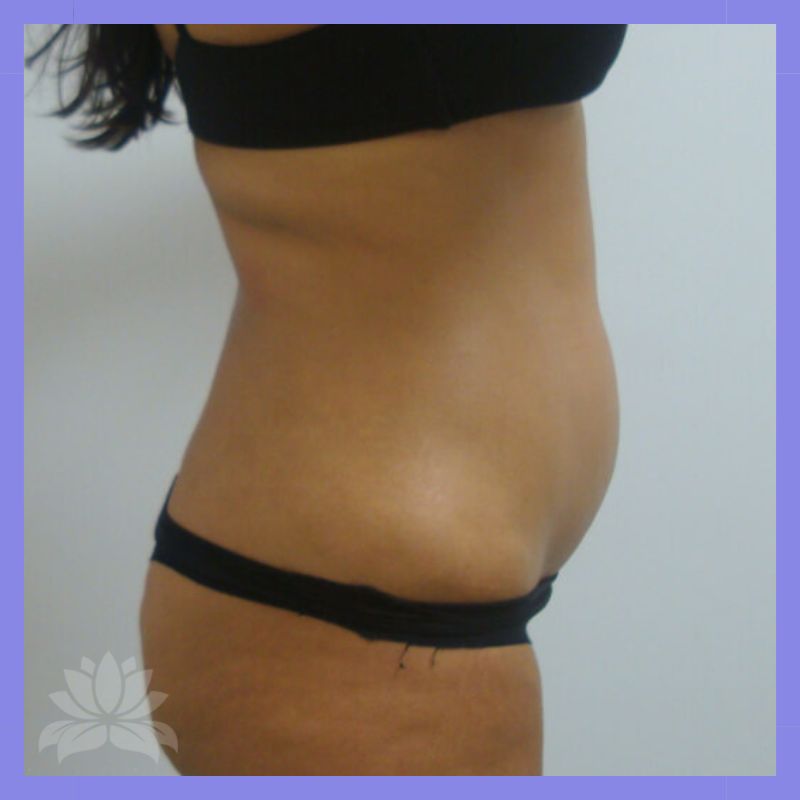 depois criolipolise lado2