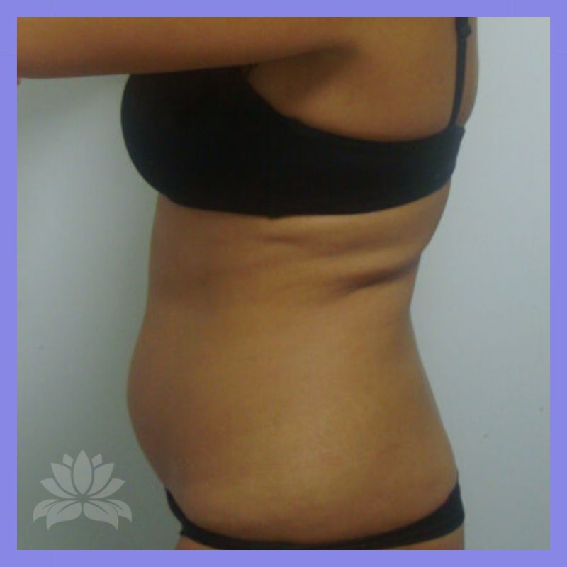 durante criolipolise lado1