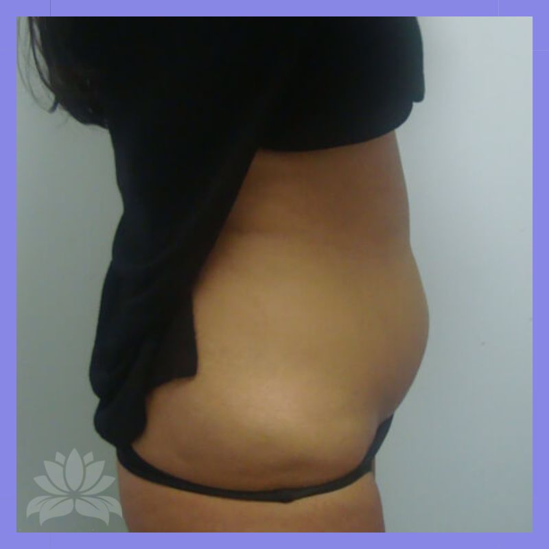 durante criolipolise lado2