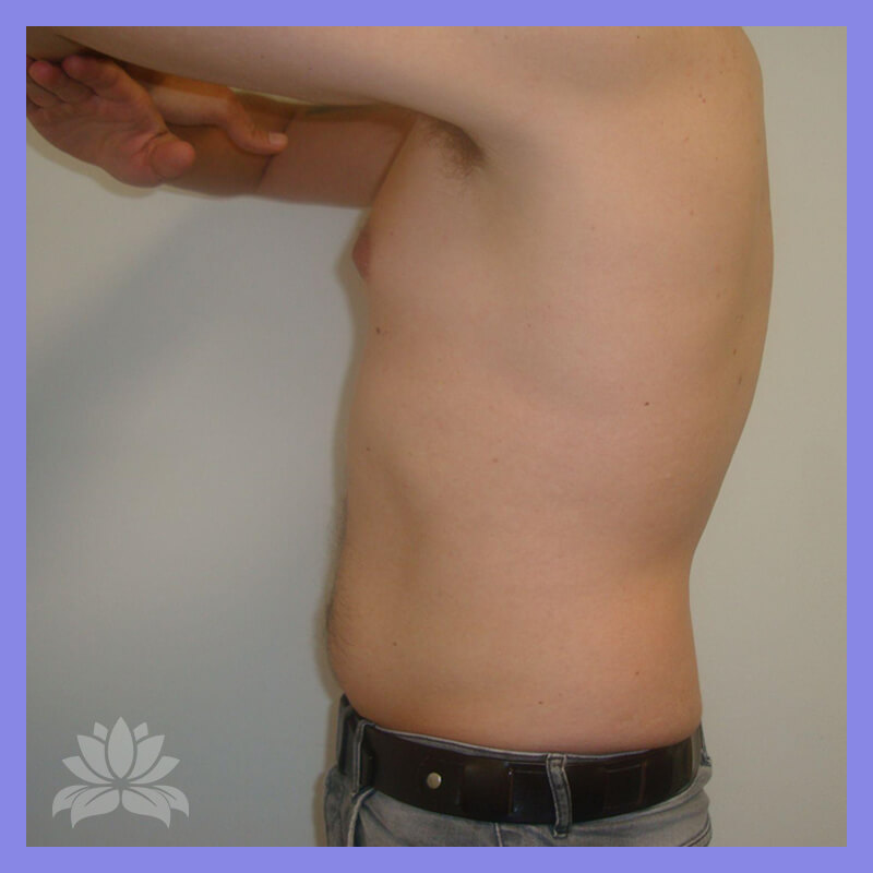 lateral direita antes