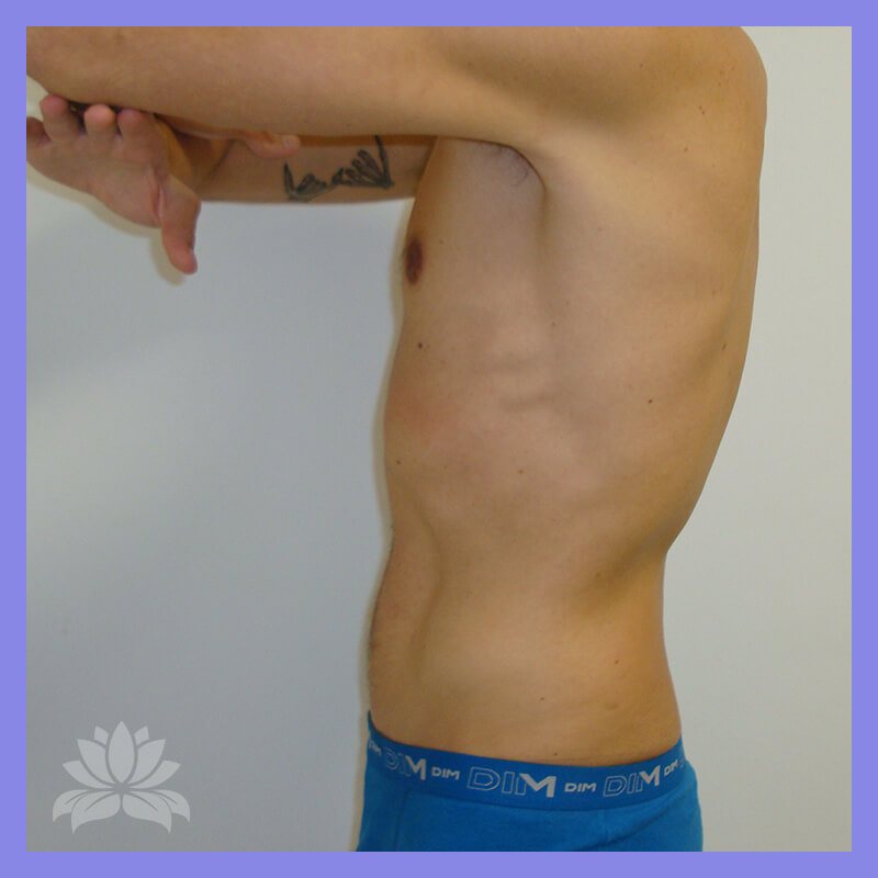 lateral direita depois