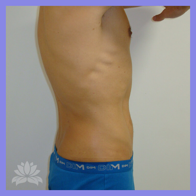 lateral esquerda depois