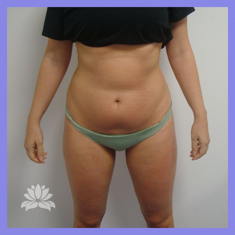 caso 376 antes e depois 1.5