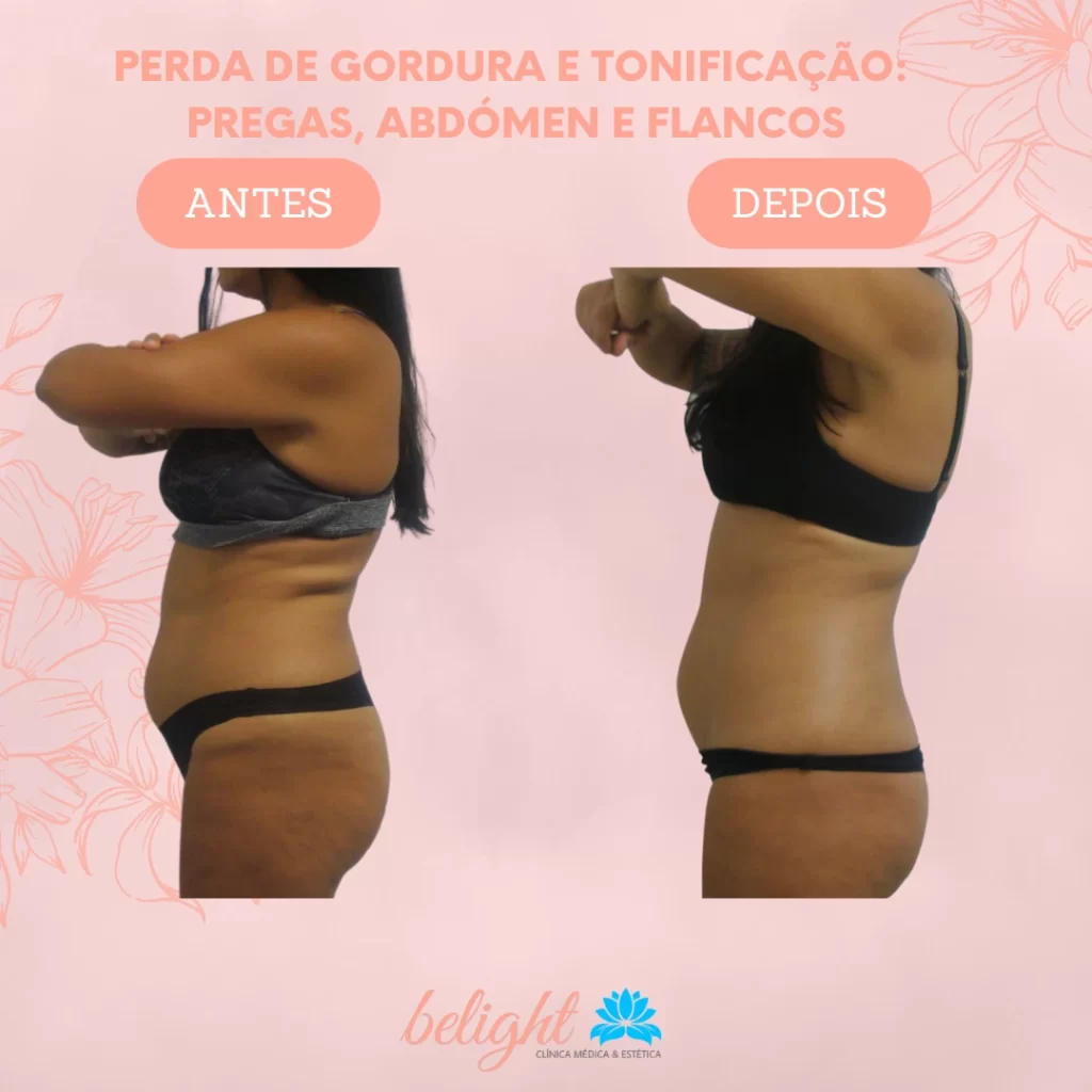 Tratamentos Realizados: Protocolo de Tratamentos Belight, Cavitação, Criolipólise, Drenagem Linfática Manual