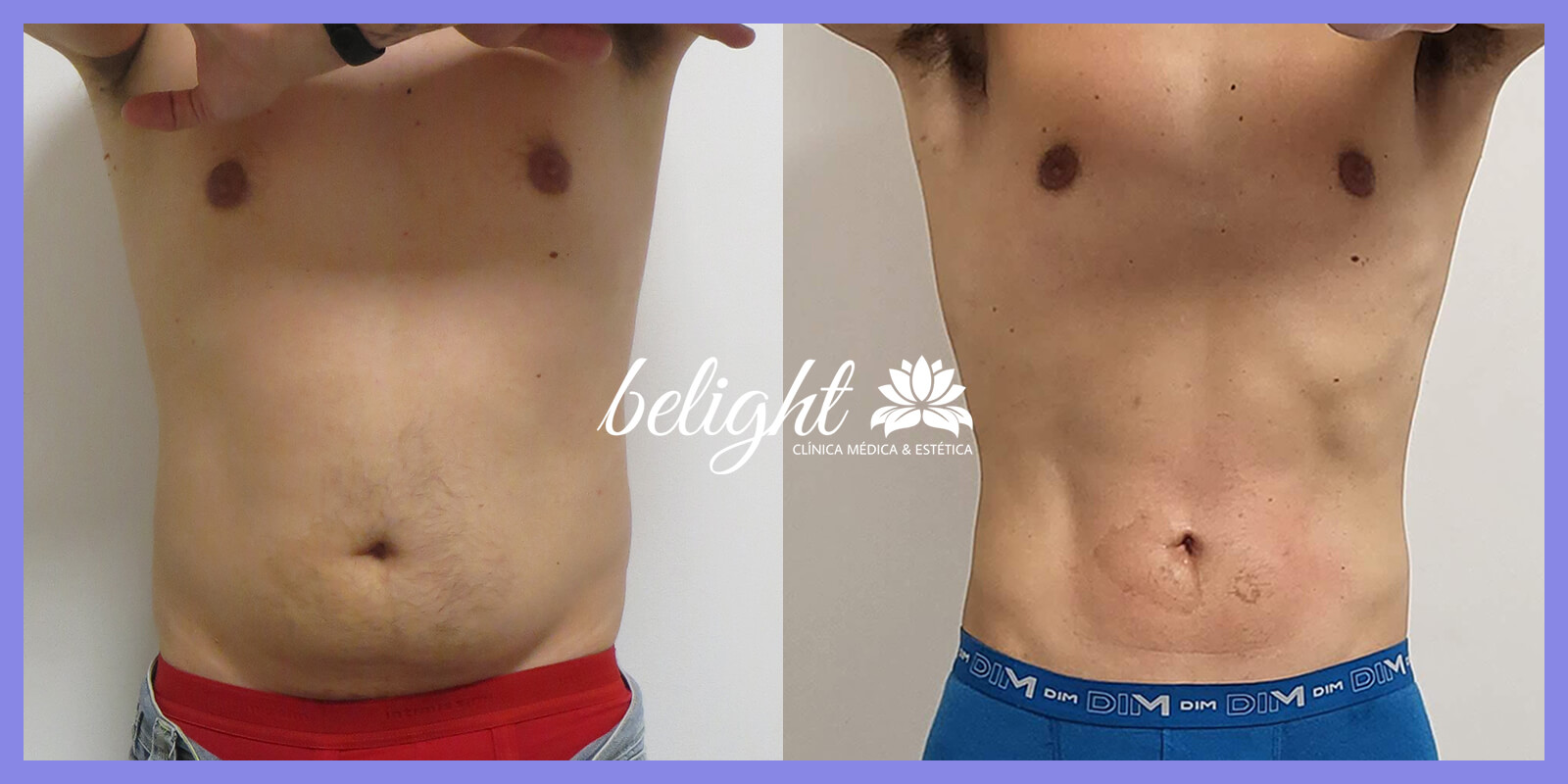 antes e depois emagrecimento