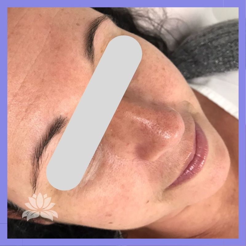 caso 285 1 0 microblading