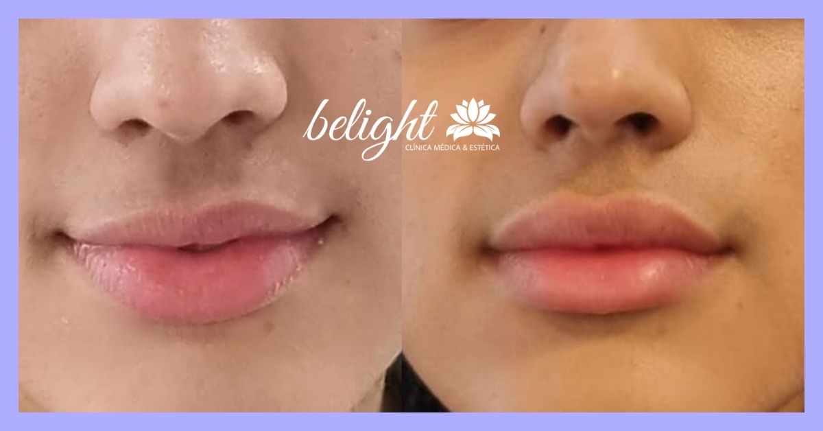 Caso 285 banner belight preenchimento labial