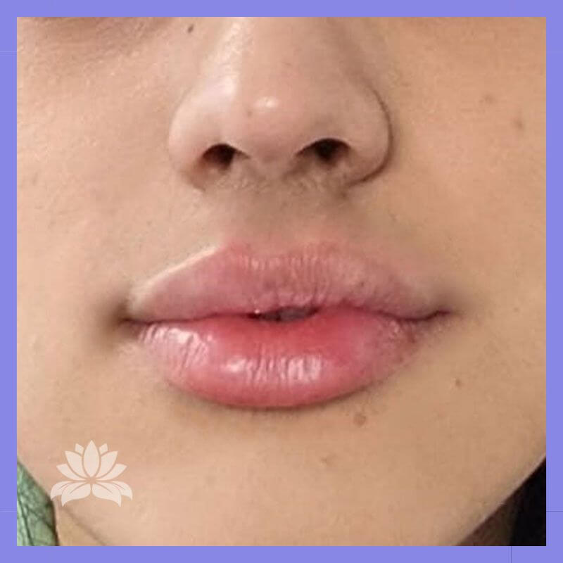 Caso 337 antes e depois 2