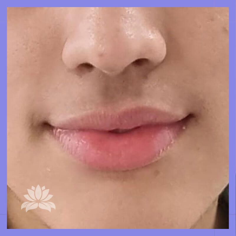 caso 337 antes e depois