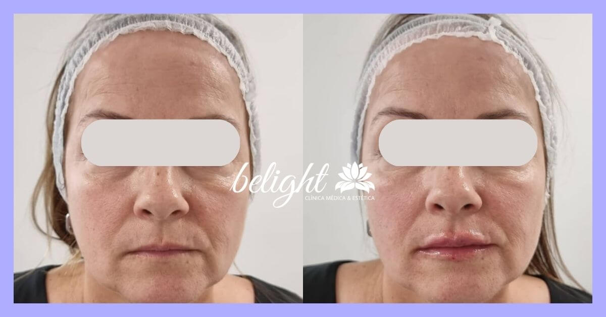 caso antes e depois preenchimento 002