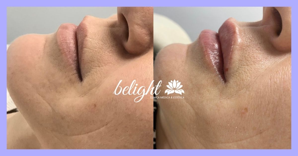 caso antes e depois preenchimento banner alexandra