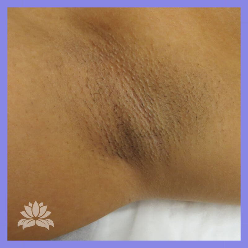 caso 22 epilacao triplo laser 1