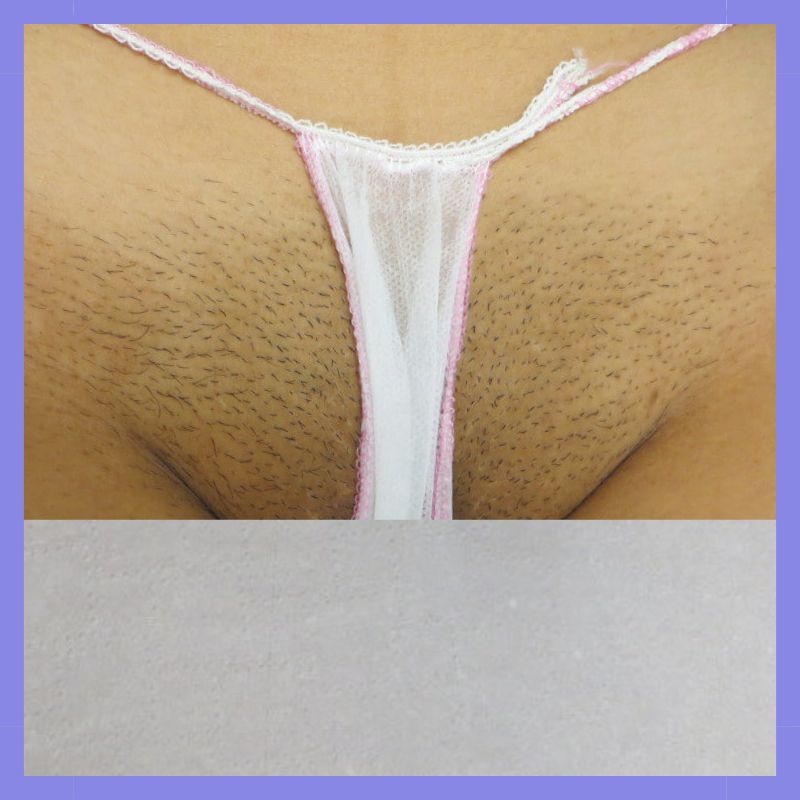 caso 22 epilacao triplo laser 3.2