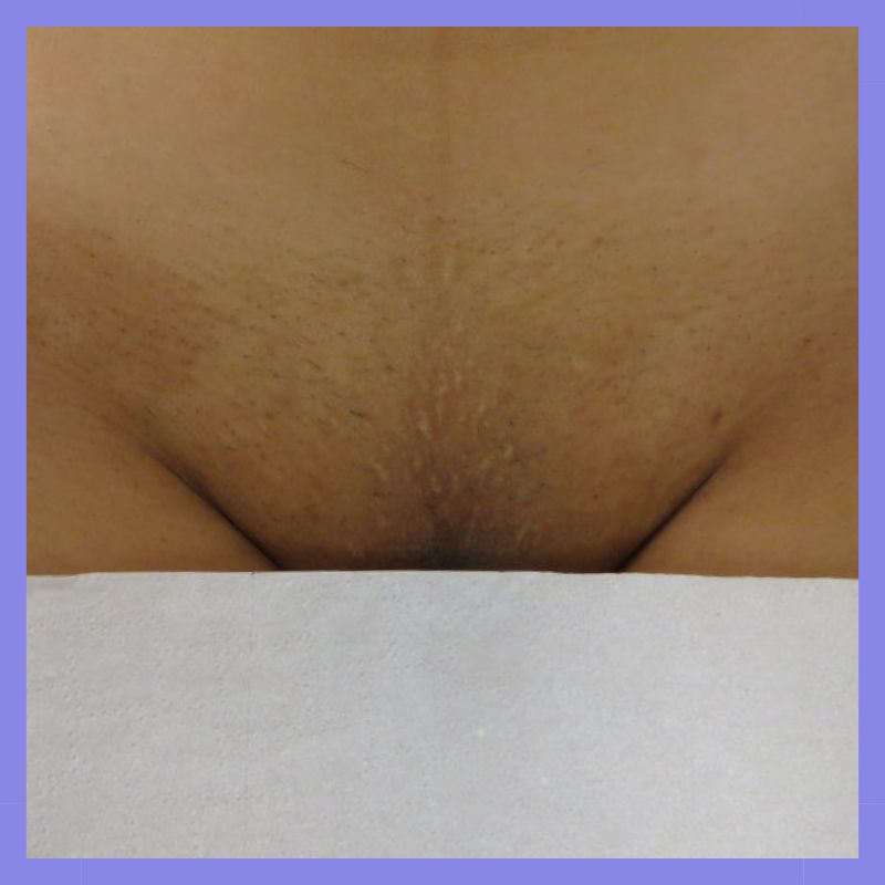 caso 22 epilacao triplo laser 4