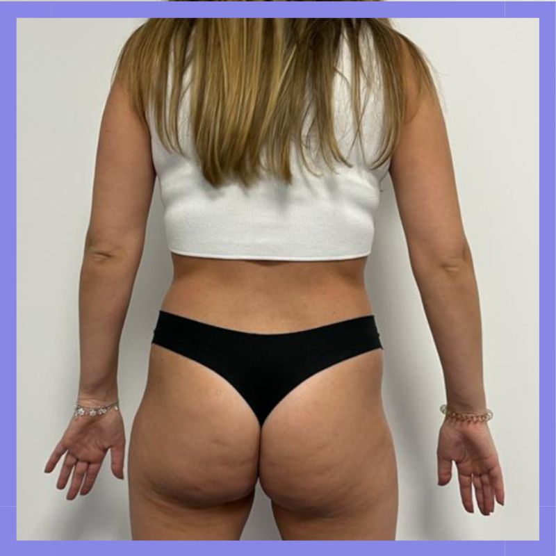 caso 147 antes e depois x wave belight 1