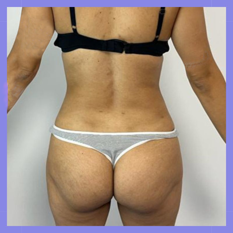 caso 23 exilis bl 10 2